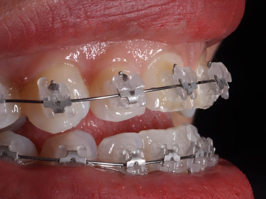 Brackets autoligados estéticos en arcada superior e inferior