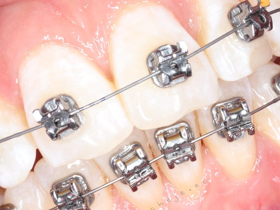 Brackets autoligados metálicos, vista de cerca