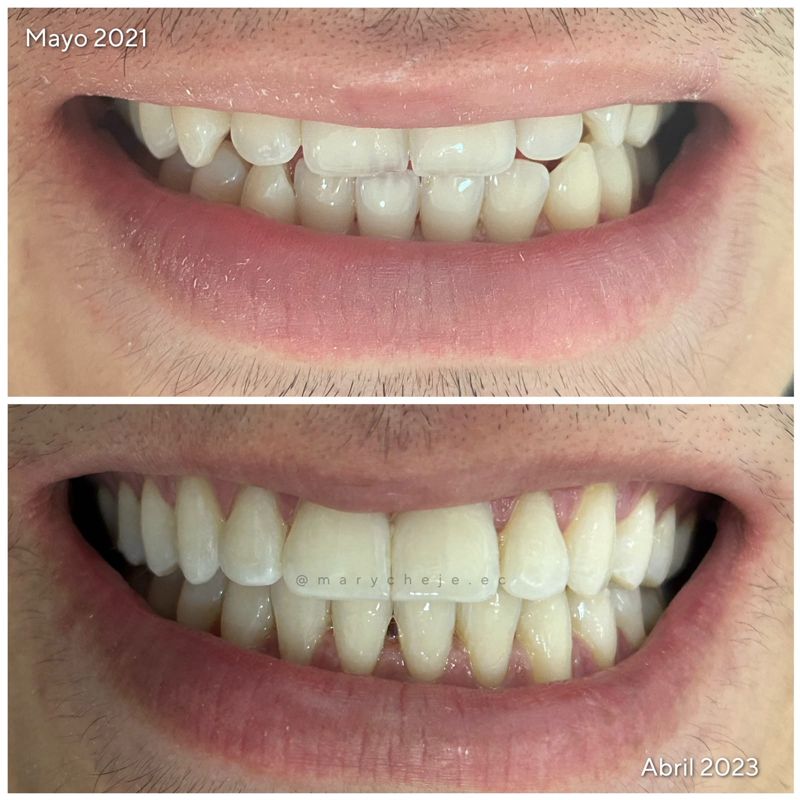 Sonrisa antes y después: mayo de 2021 y abril de 2023