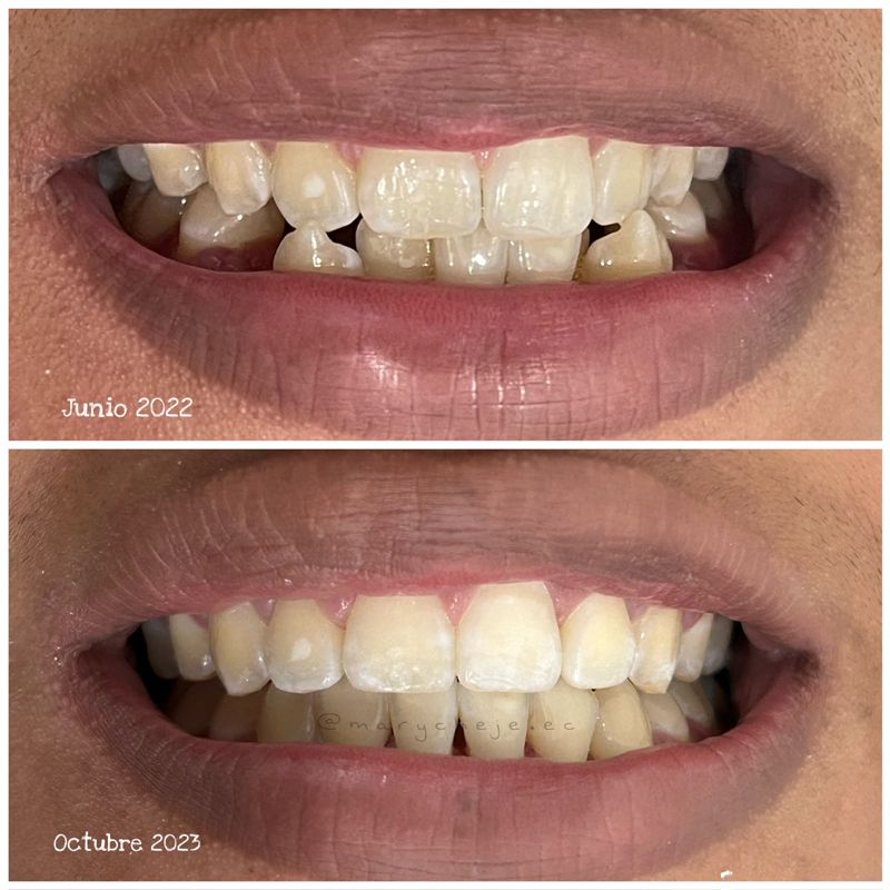 Sonrisa antes y después: junio de 2022 y octubre de 2023