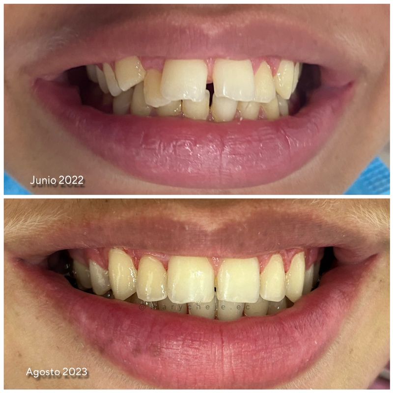 Sonrisa antes y después: junio de 2022 y agosto de 2023