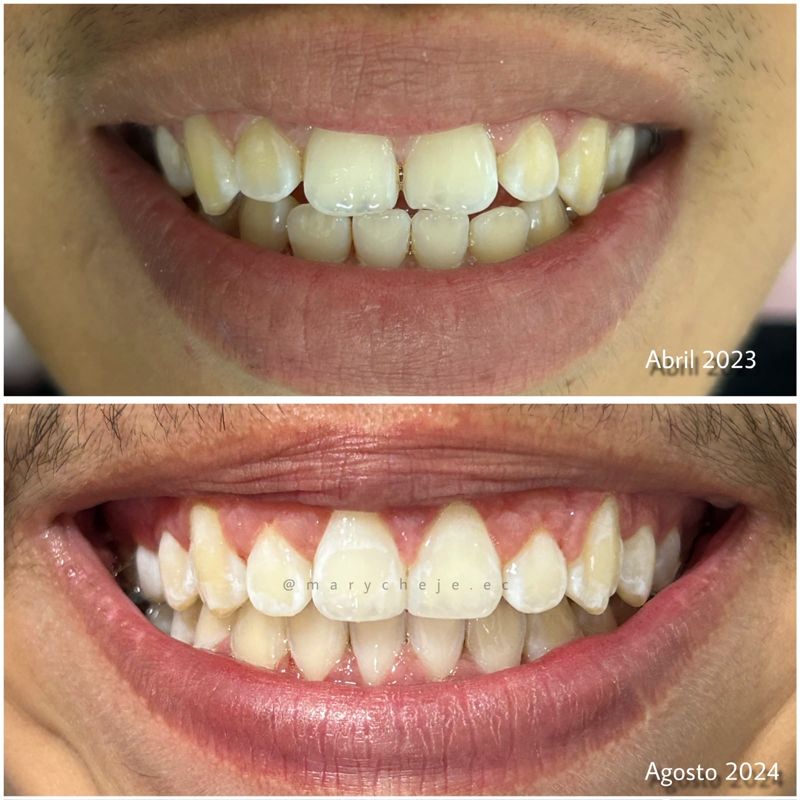 Sonrisa antes y después: abril de 2023 y agosto de 2024