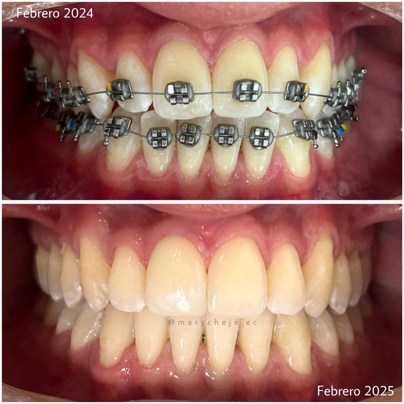 Vista de frente: febrero de 2024 con brackets y febrero de 2025 al terminar