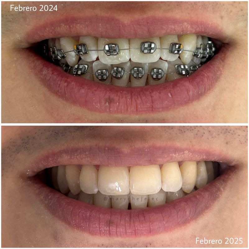 Sonrisa: febrero de 2024 con brackets y febrero de 2025 al terminar