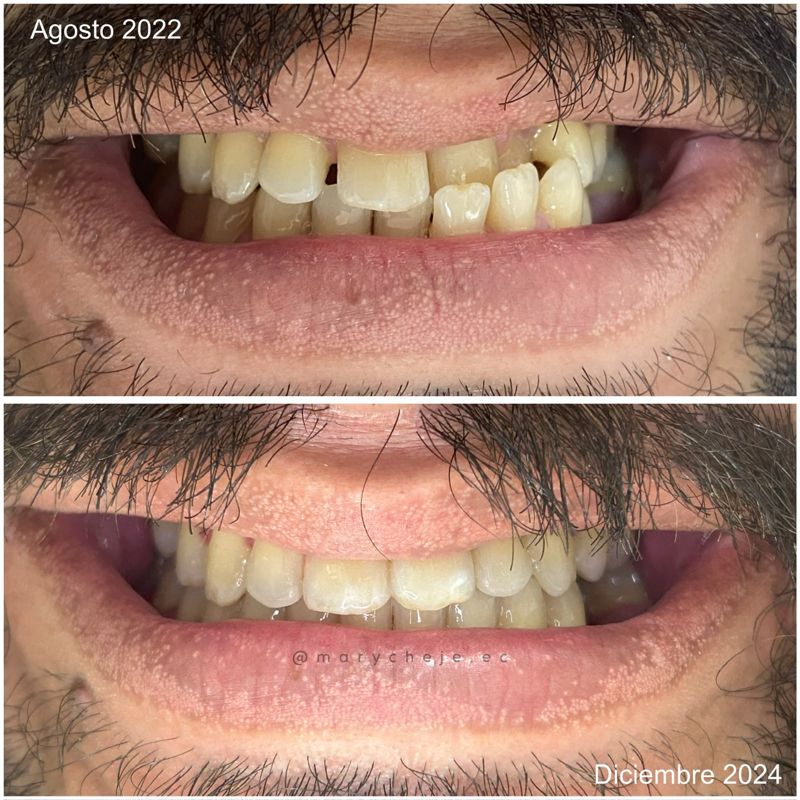 Sonrisa antes y después: agosto de 2022 y diciembre de 2024