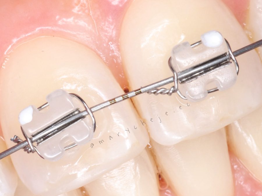 Detalle de dos brackets cerámicos con el arco