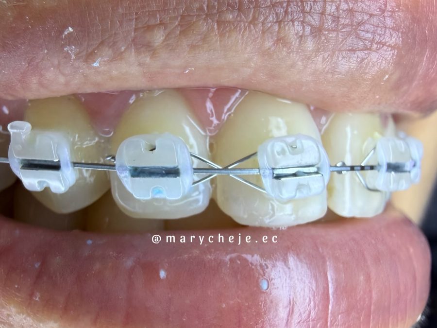 Brackets cerámicos en dientes superiores, vista lateral