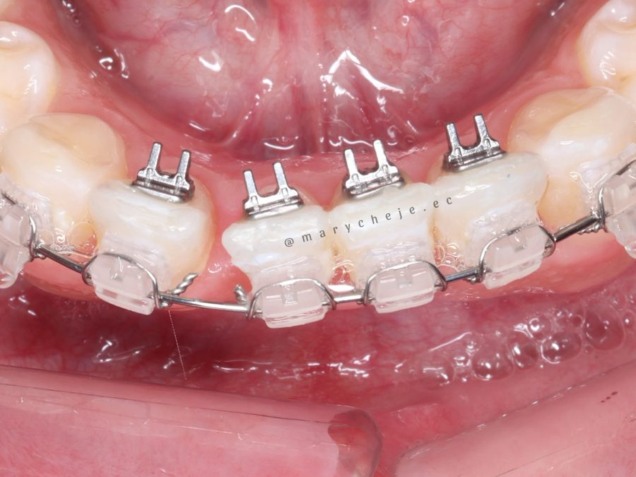 Educadores linguales en los dientes anteriores inferiores, con brackets estéticos