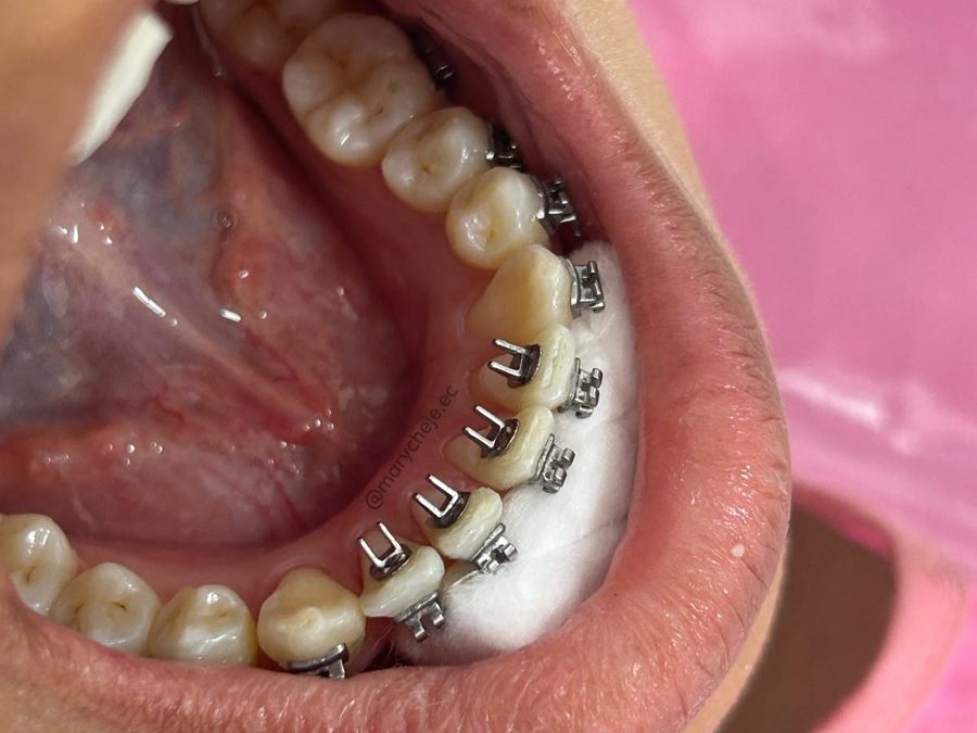 Educadores linguales adheridos por la cara interna de los dientes inferiores