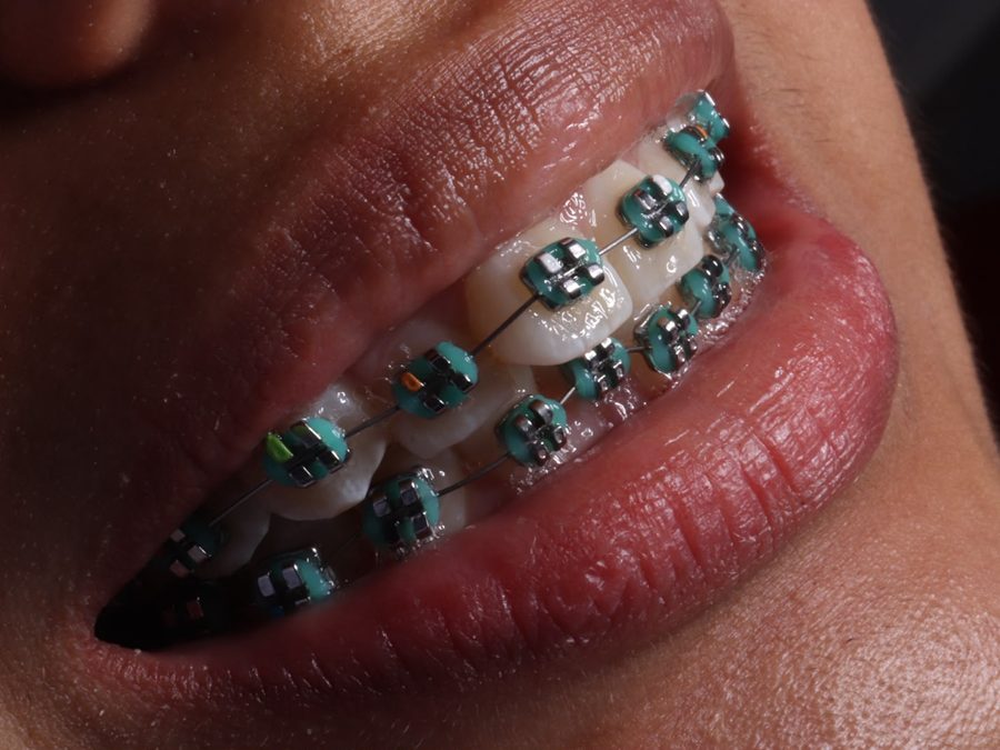 Brackets metálicos con ligas de color