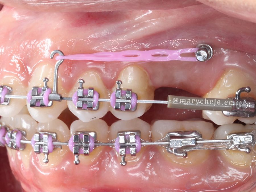 Mini implante con cadena elástica rosada conectada a los brackets