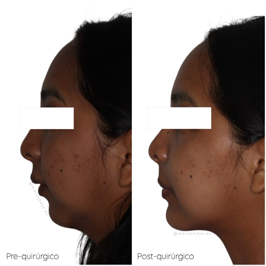 Perfil facial antes y después de la cirugía, con los ojos cubiertos