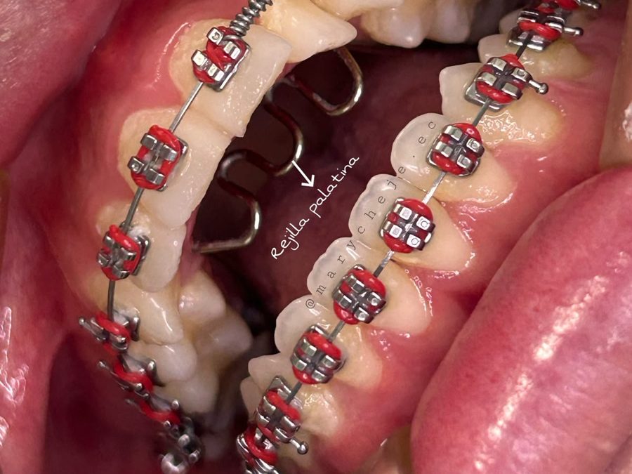 Rejilla palatina detrás de los dientes superiores, junto con brackets metálicos