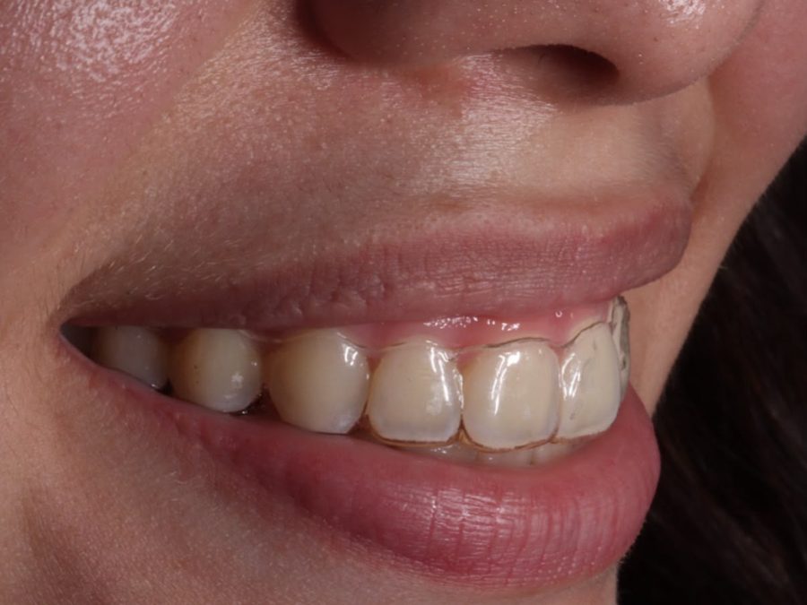 Retenedor de acetato en la sonrisa, vista lateral