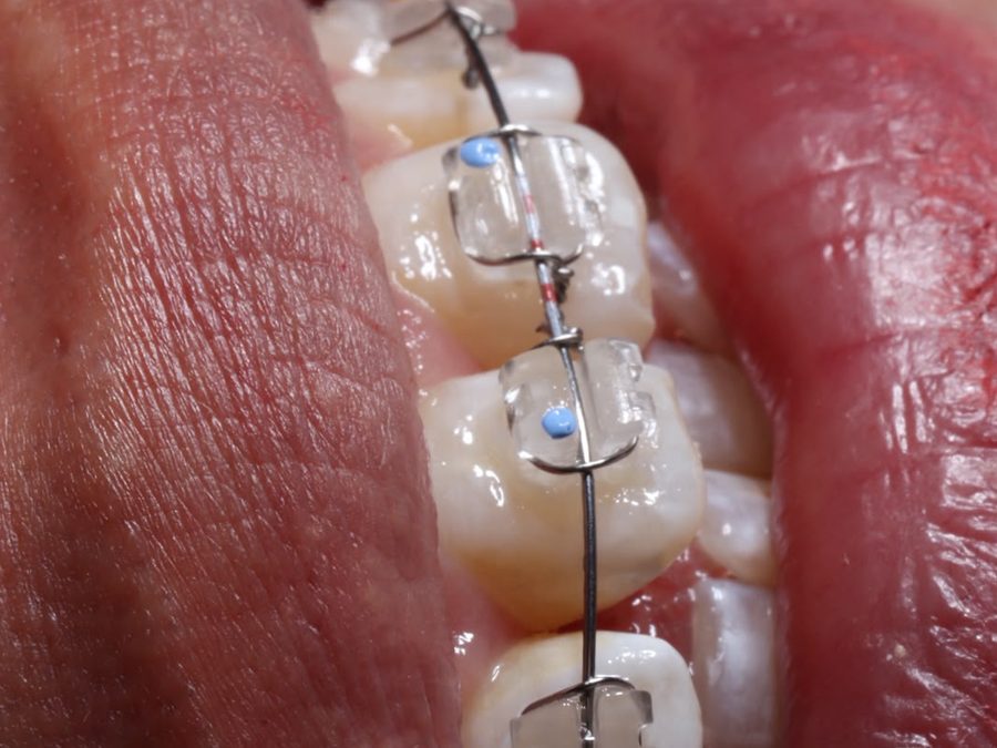 Brackets de zafiro, vista de cerca